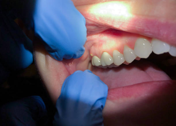 Best Emergency Root Canal Treatment in Poulsbo, WA