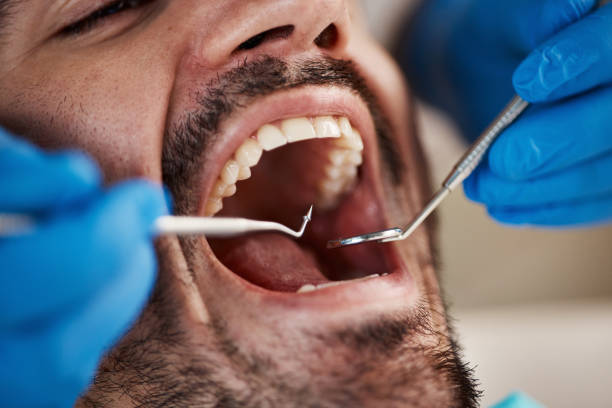 Best Broken or Cracked Tooth Emergency Dentist in Poulsbo, WA