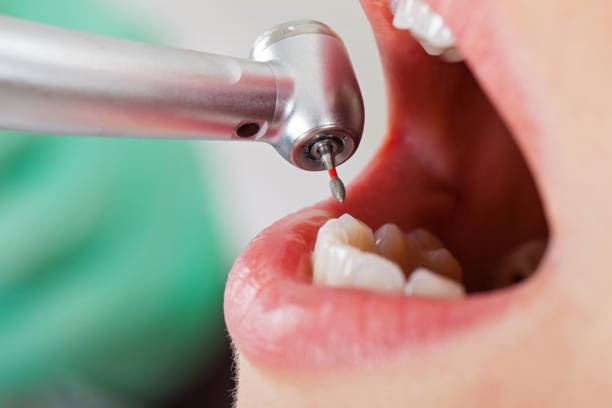 Best Emergency Dentist for Lost Fillings or Crowns in Poulsbo, WA
